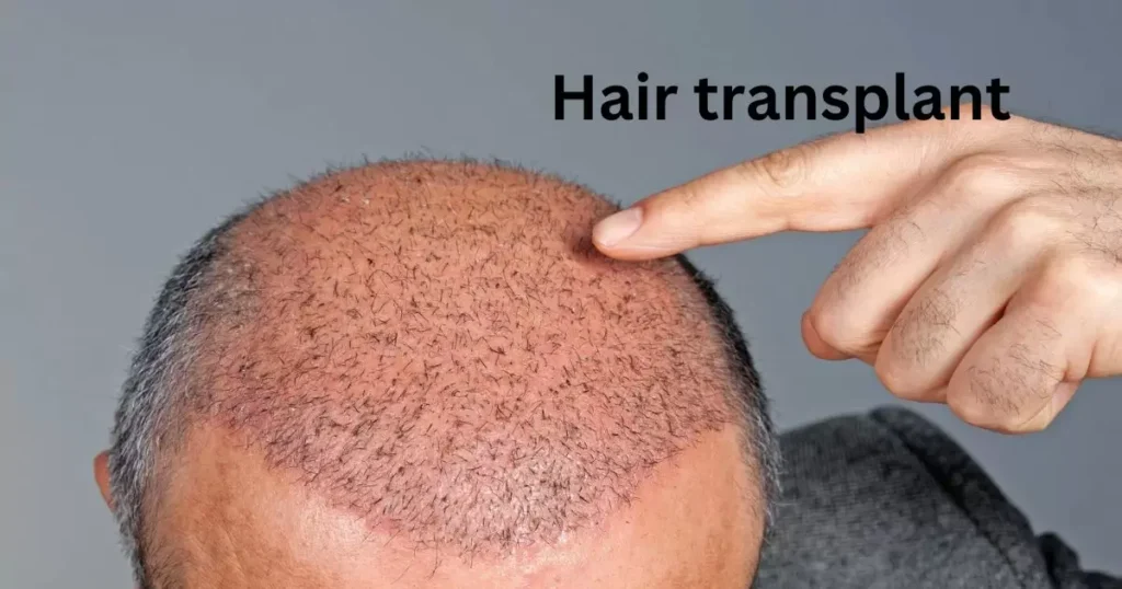 Hair transplant