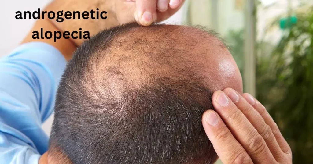 Androgenetic alopecia