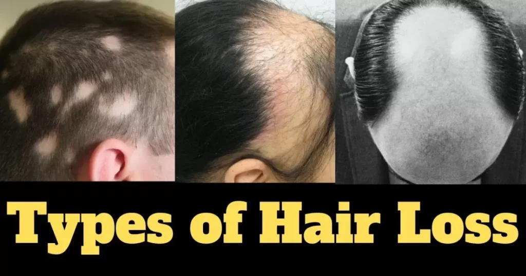 Different types of hair loss