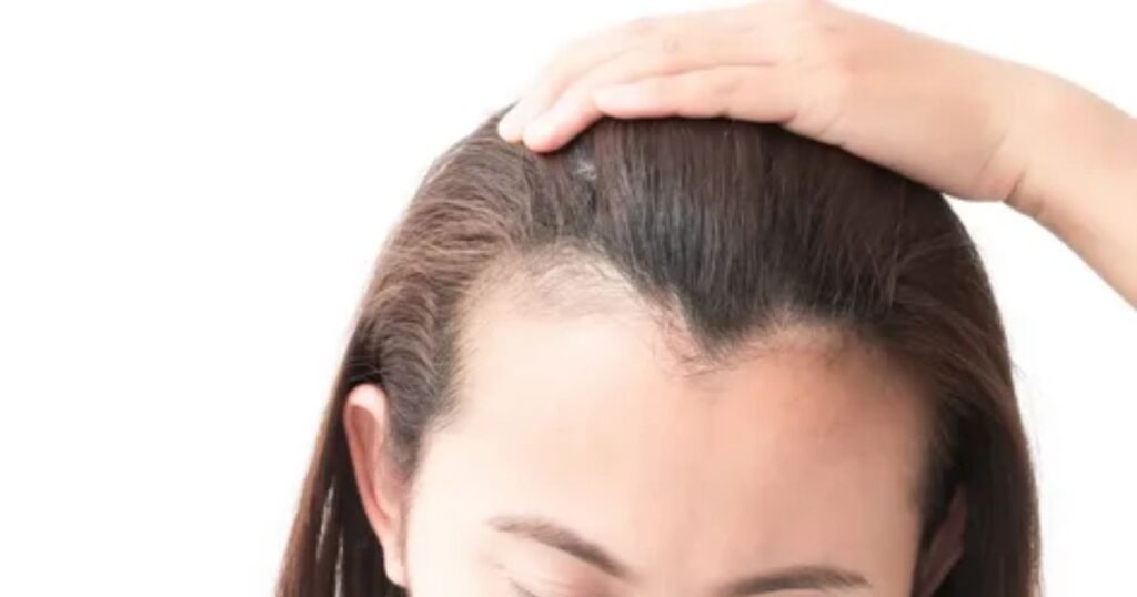 how to stop a receding hairline woman?