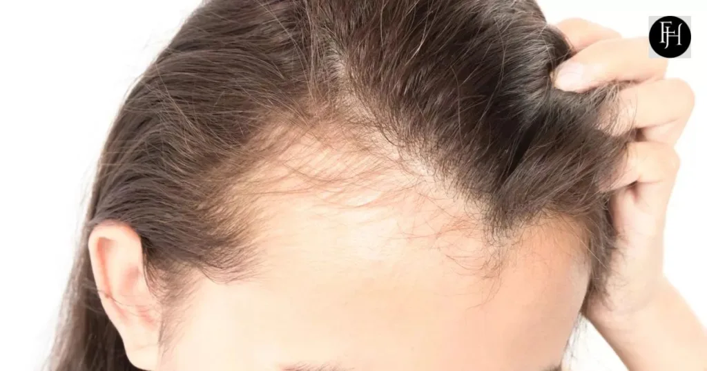 How to Fix Uneven Hairline women?